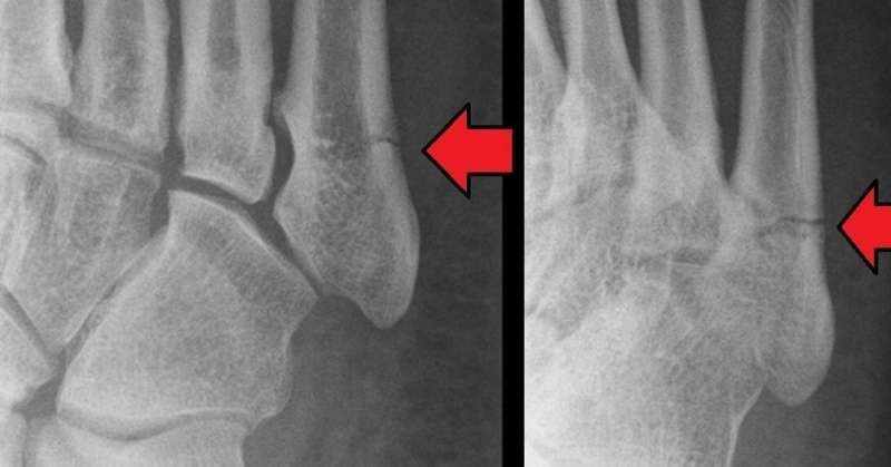 metatarsal bone fracture x ray