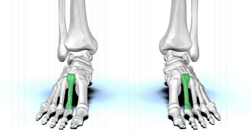 metatarsal bones